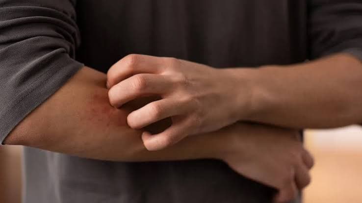 Aumento dei casi di dermatofilosi in Europa. Pregliasco: «Rischio contenuto, ma le modalità di trasmissione stanno mutando»